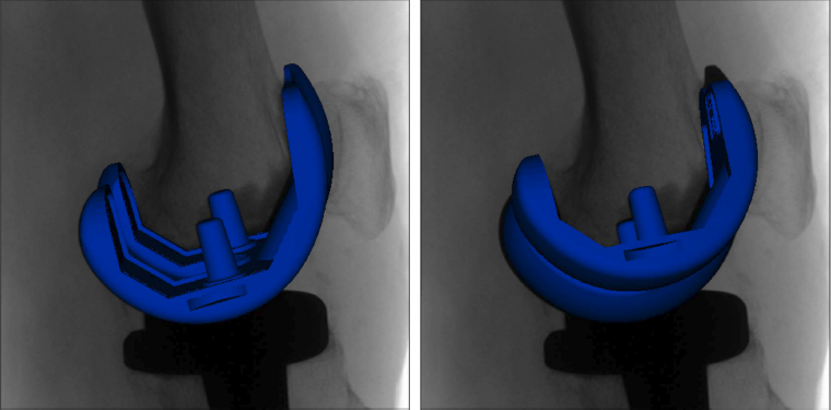 Femoral implant model in two different orientations